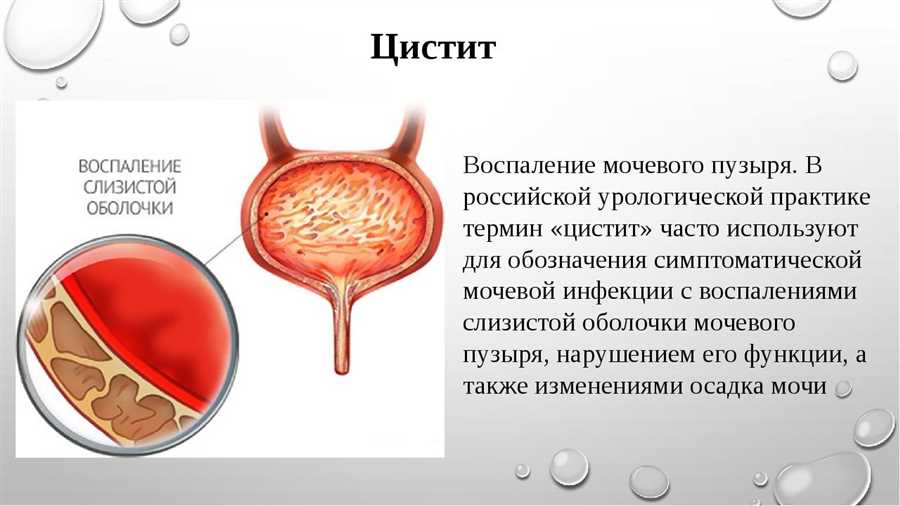 Можно ли застудить мочевой пузырь женщине